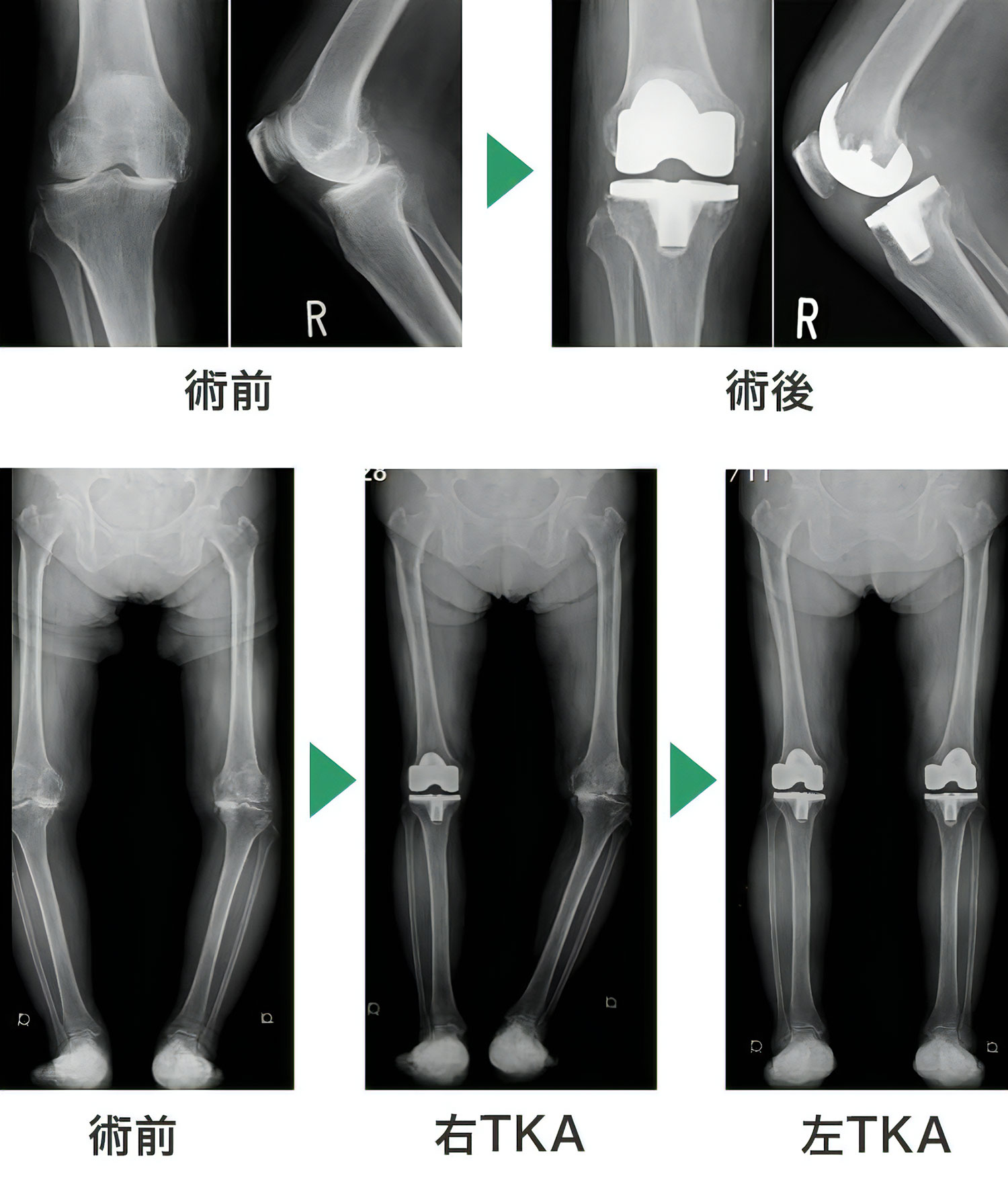 膝関節TKAの術前・術後の写真