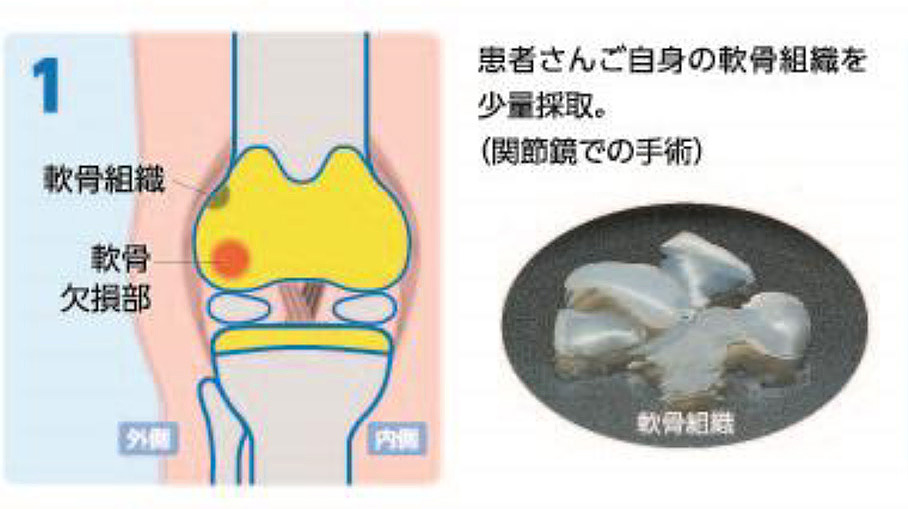 1.患者さん自身の軟骨組織を少量採取