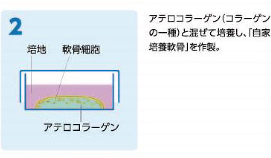 2.アテロコラーゲンと混ぜて培養し、自家培養軟骨を作成