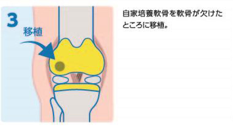 3.自家培養軟骨を、軟骨が欠けたところに移植