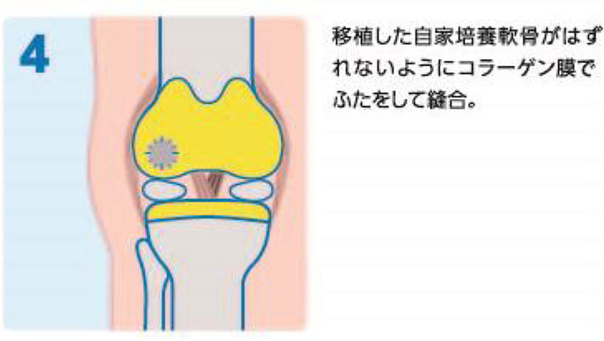4.移植した自家培養軟骨がはずれないようにコラーゲン膜で蓋をして縫合