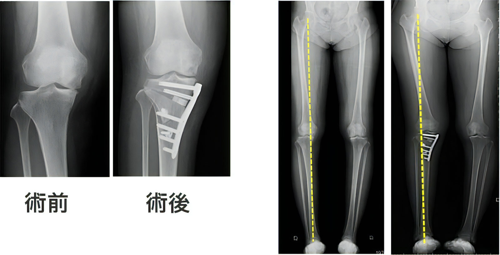 骨切り術の術前・術後の写真