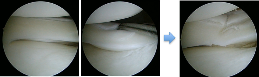 半月板縫合術
