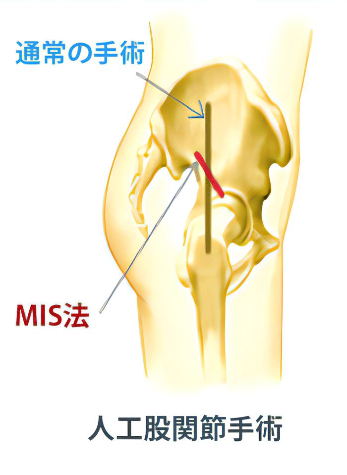 MIS法の図解